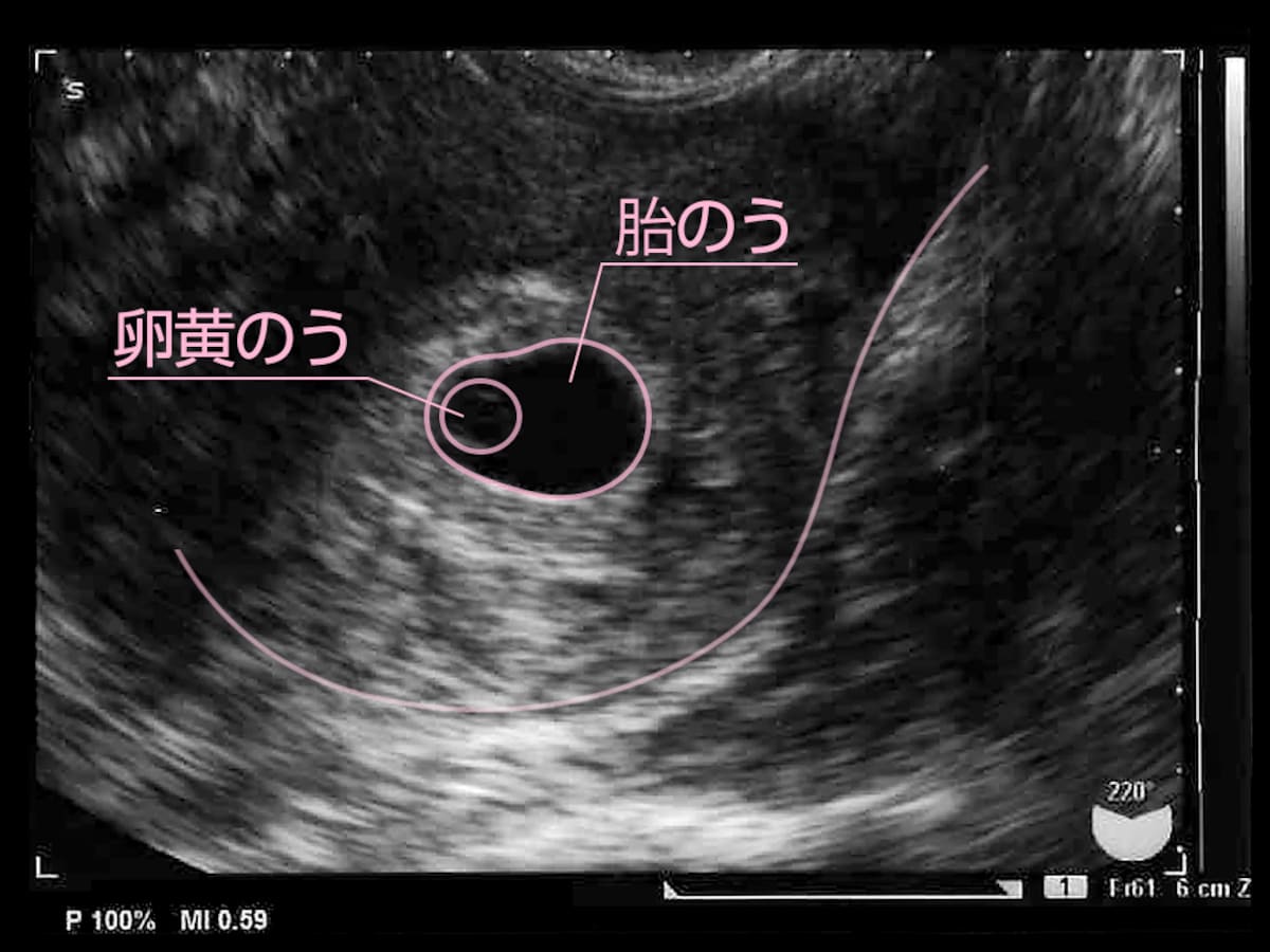 妊娠5週目 胎嚢の大きさ エコー写真 つわり症状や流産のこと 妊娠初期 All About