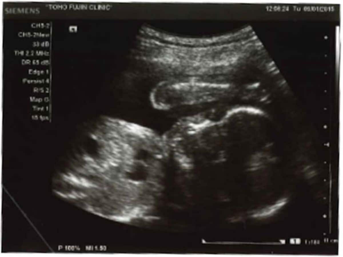 妊娠32週目 逆子は治る 胎児の体重や大きさをエコー写真で確認 妊娠後期 All About