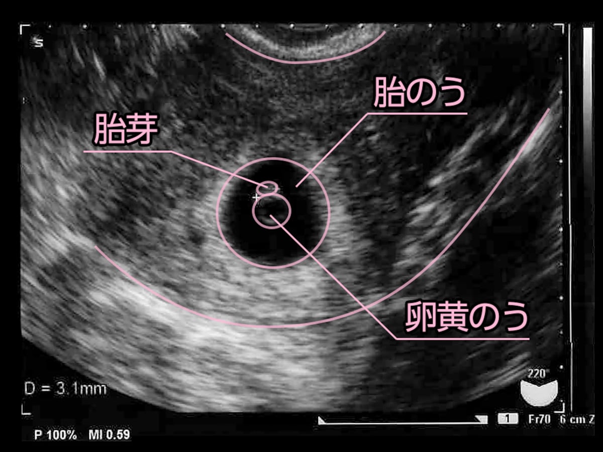 妊娠6週目 エコー写真・胎芽や胎嚢大きさ・心拍確認や気になる流産 [妊娠初期] All About