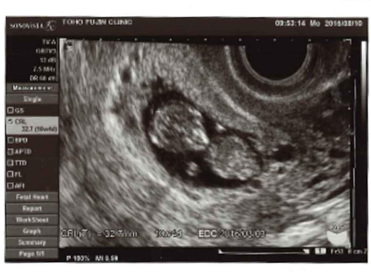 妊娠10週目 エコー写真や胎児の大きさ 10週の壁 流産原因や症状