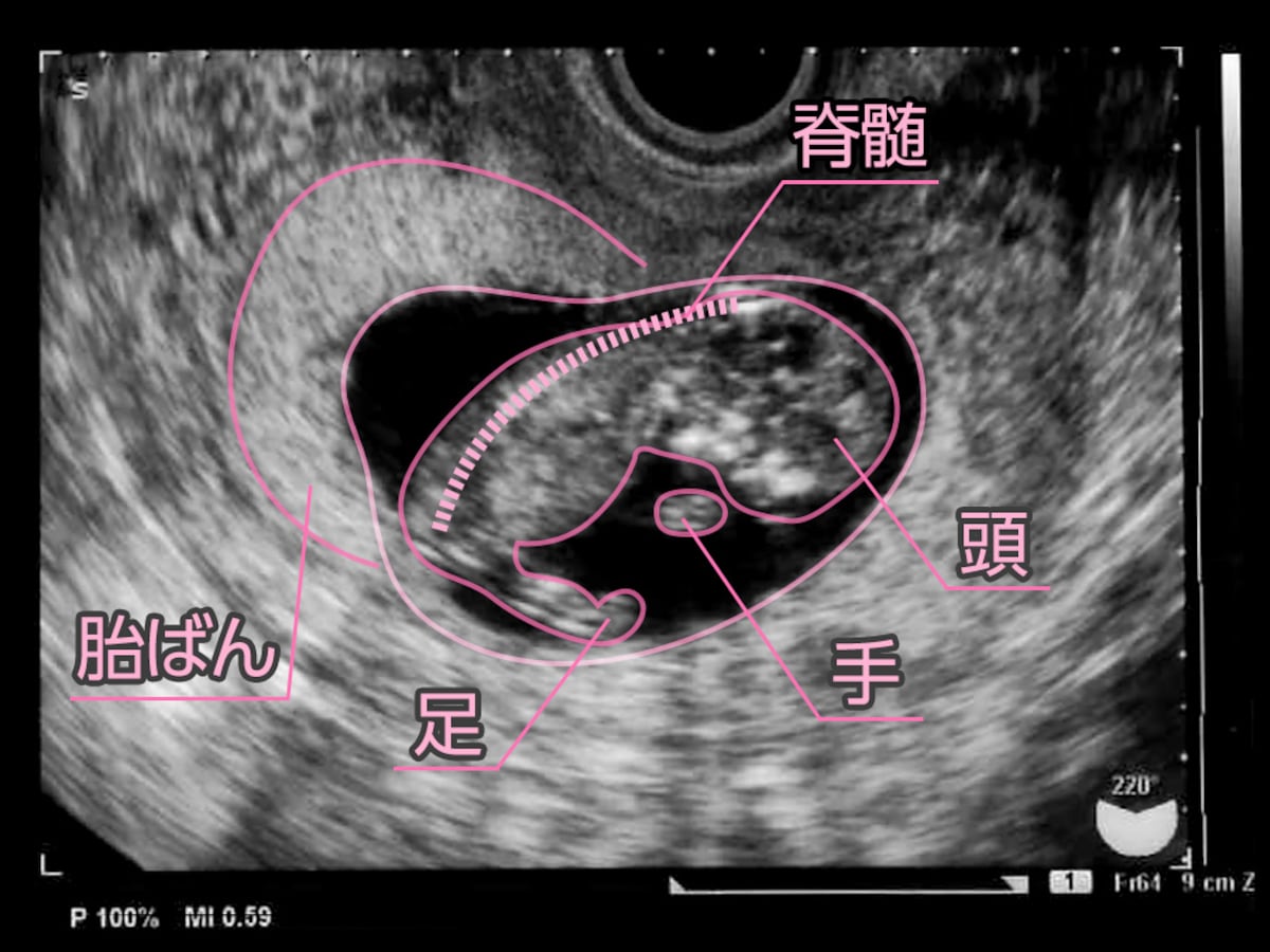 妊娠11週目エコー写真や胎児の大きさ平均 流産原因や症状 妊娠初期