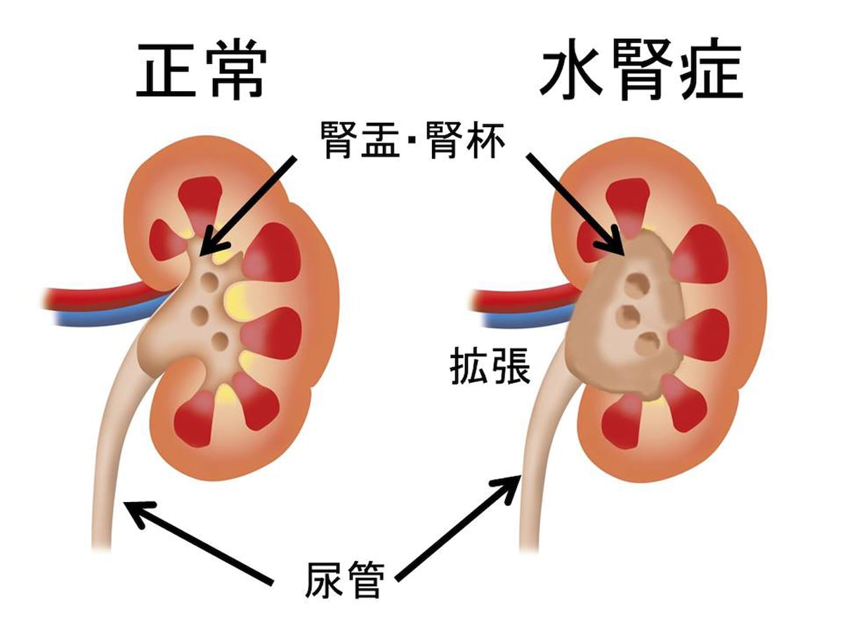 子どもの水腎症の症状 原因 治療法 感染症 All About