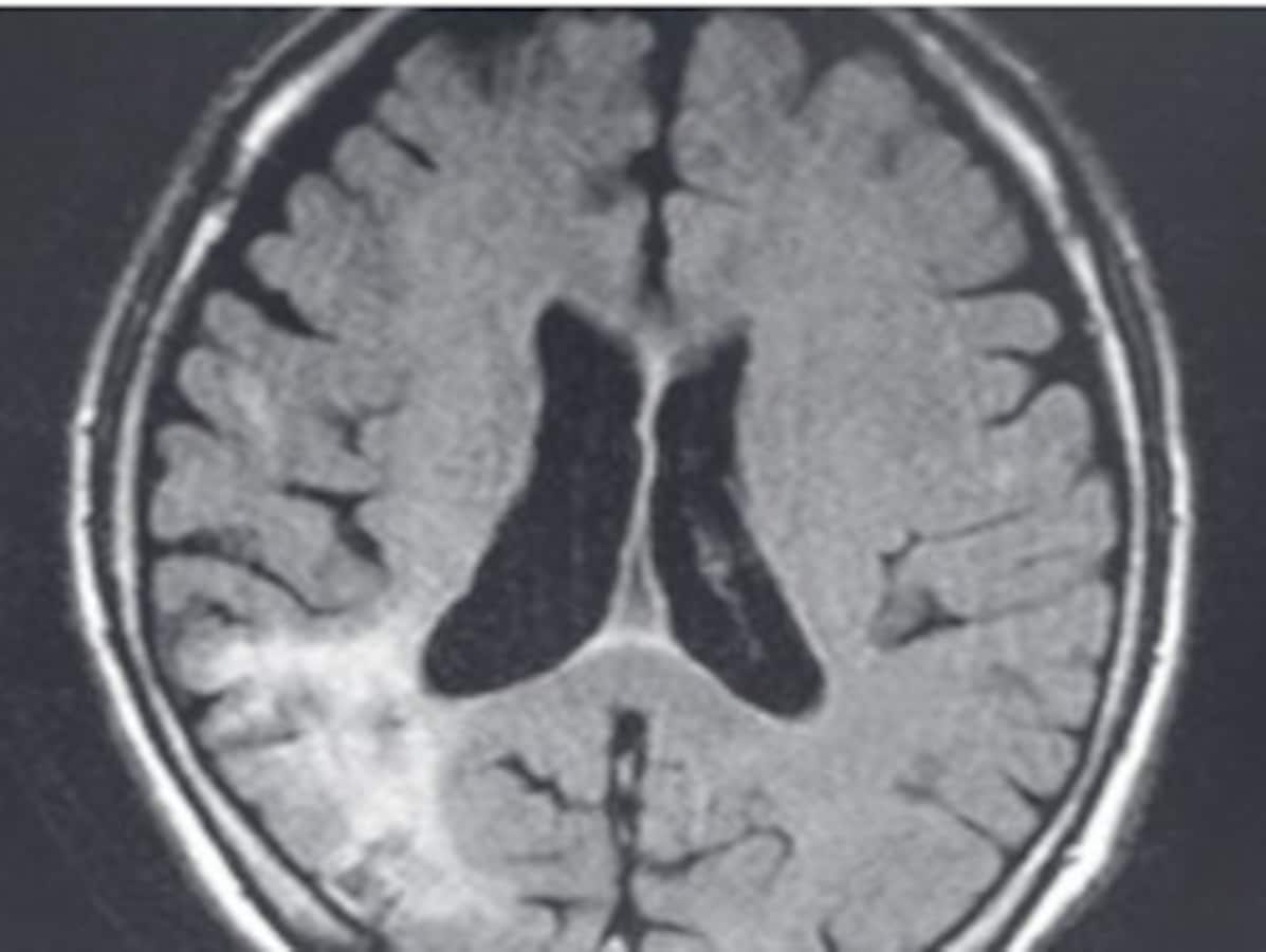 理学療法士（PT）国試 脳血管障害の問題傾向 [理学療法士] All About