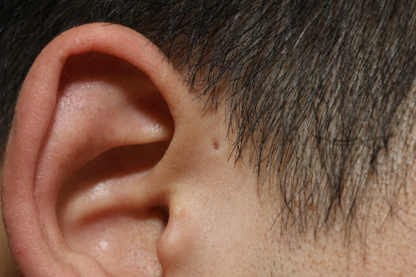 耳瘻孔・先天性耳瘻孔とは……腫れ・臭いがあれば手術も【画像あり】 [皮膚・爪・髪の病気] All About