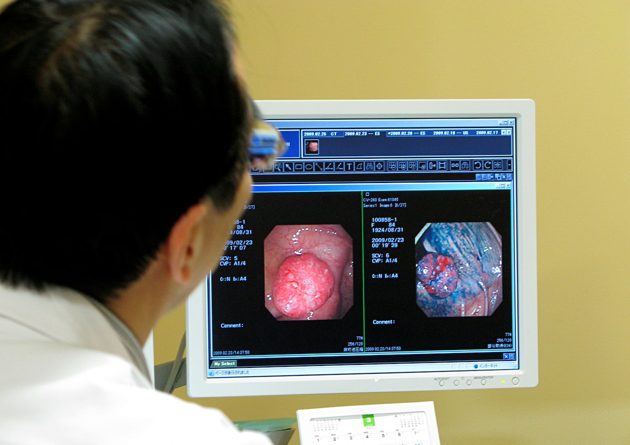 大腸ポリープと言われたら 原因 切除適応 予防法 胃腸の病気 all about