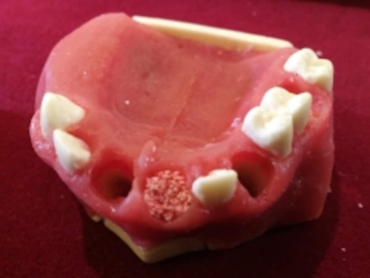 ソケットプリザベーション…歯槽堤保存術 [歯科インプラント] All
