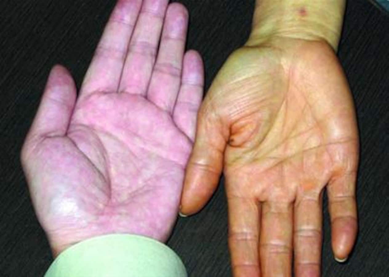 みかんを食べ過ぎるとなぜ皮膚が黄色くなるのか 皮膚 爪 髪の病気 All About