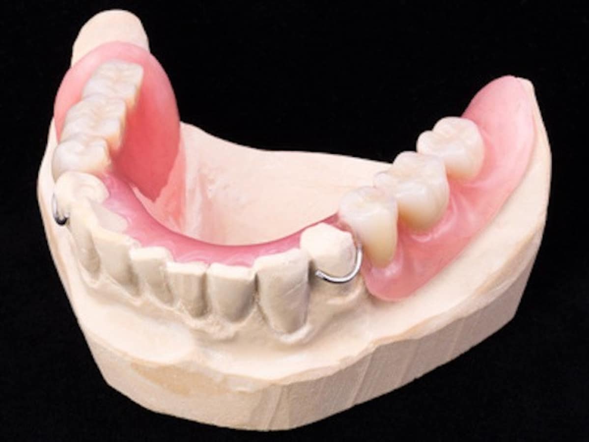 部分 入れ歯 の 種類