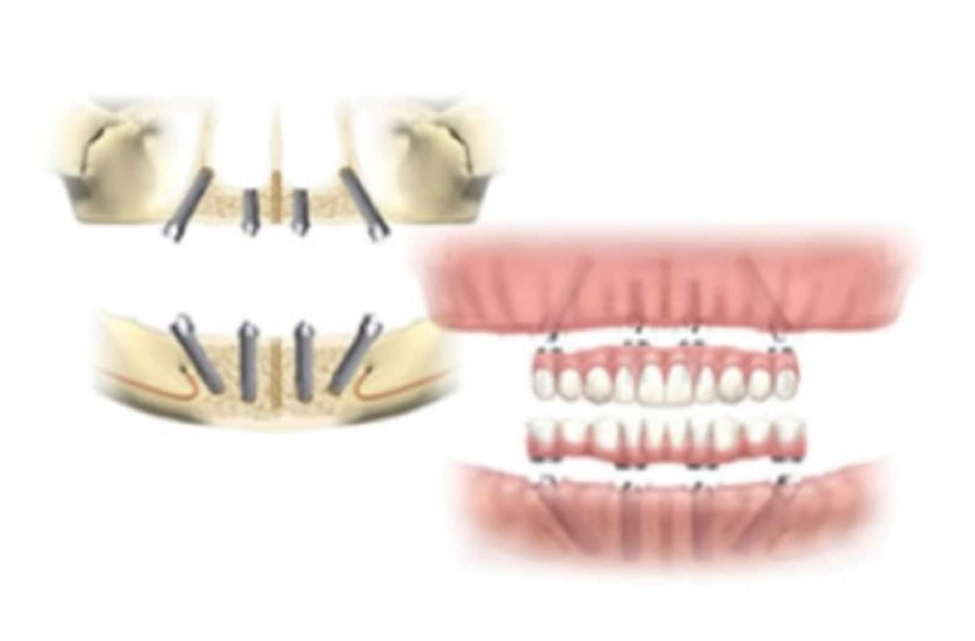 総義歯からのインプラント オールオン4 とは 歯科インプラント All About