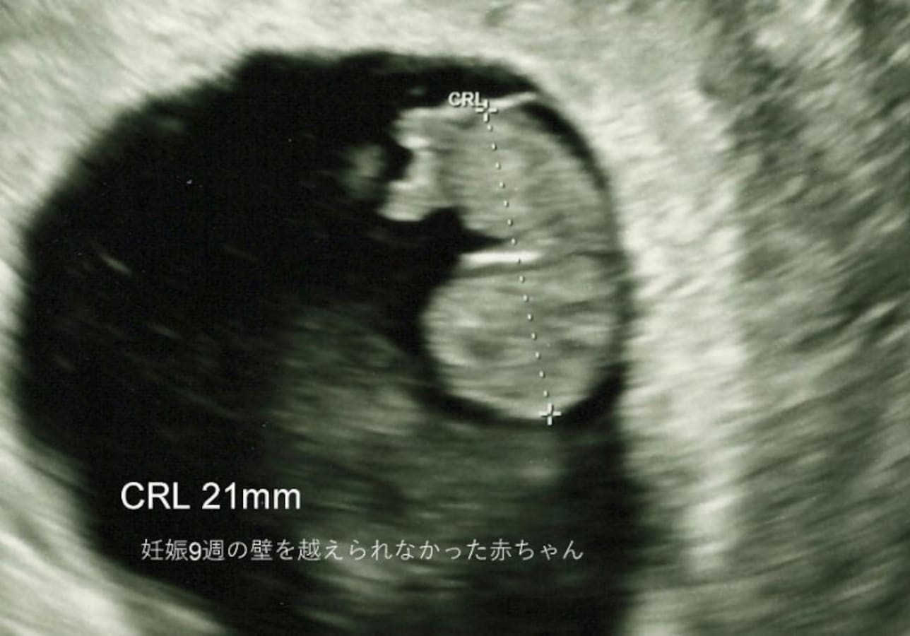 胎芽 見え 週 ない 7 妊娠5週～7週 胎芽見えない