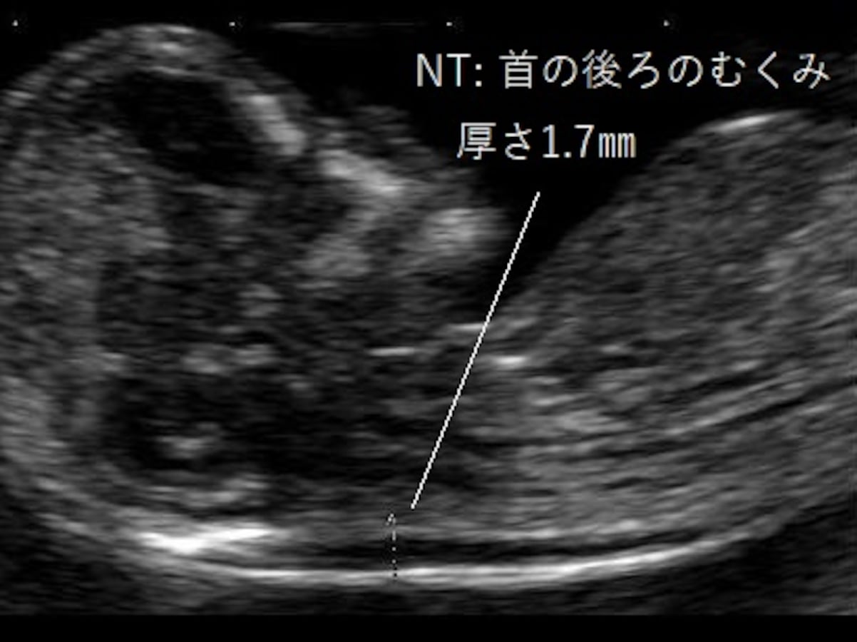 胎児の首の後ろのむくみ 浮腫 Nt とは 妊娠初期 All About