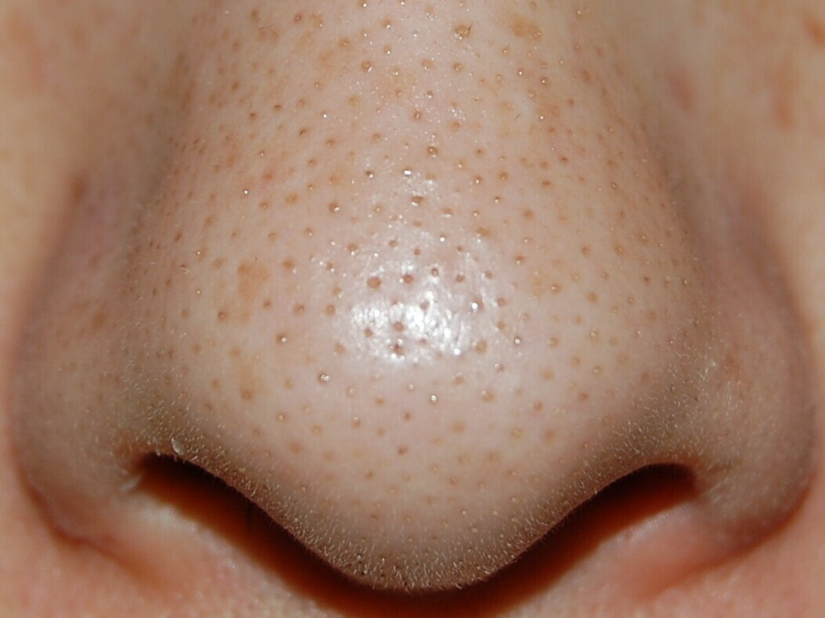 黒ずみとは何ですか?