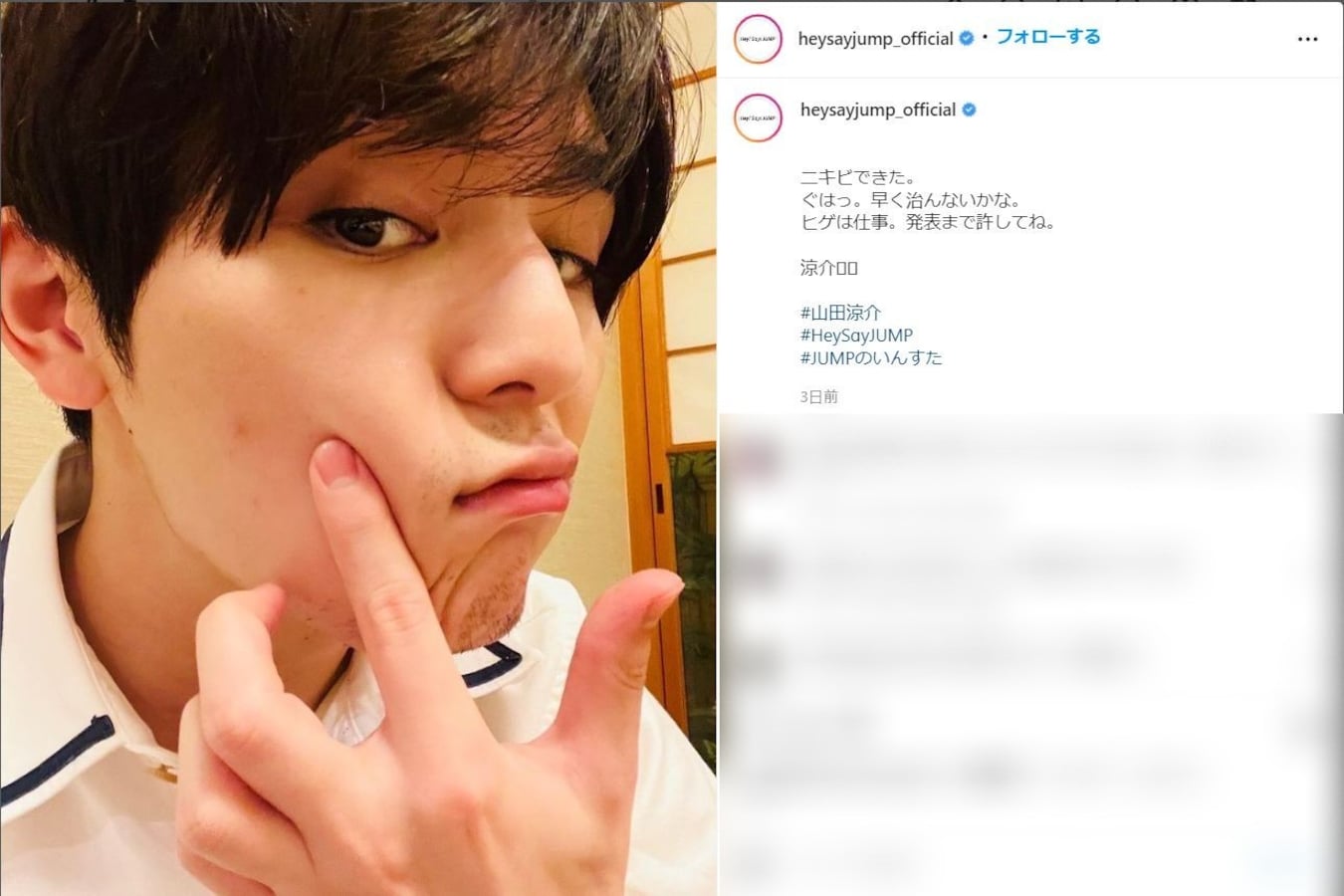 山田涼介 ヒゲ姿で ニキビできた 報告に 同じ人間なんだ ニキビも愛しい と安堵の声続々 All About News 山田涼介 ヒゲ姿で ニキビできた 報告に 同じ人間なんだ ニキビも愛しい と安堵の声続々 All About News