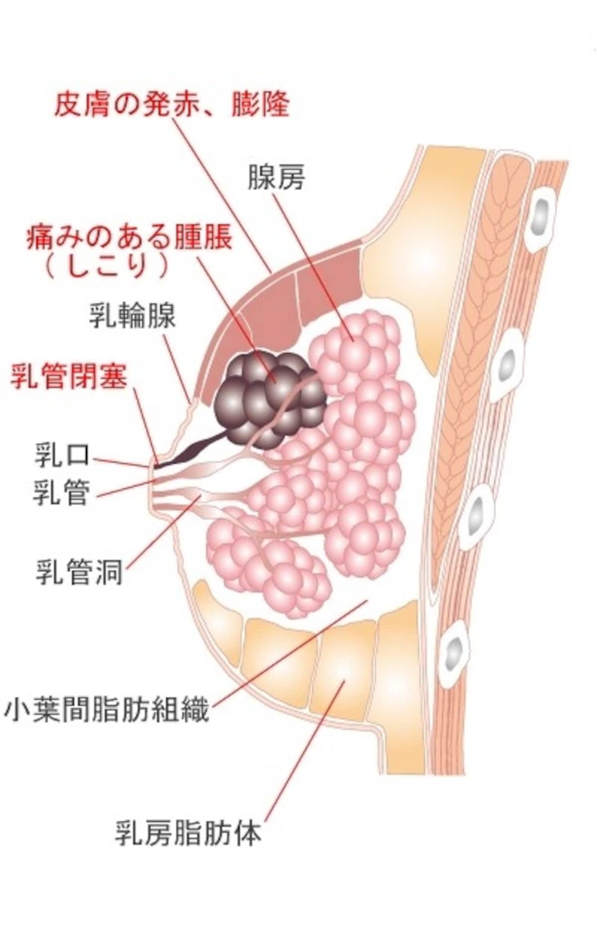 乳腺炎の治し方には、マッサージや食事による方法と、上の画像のように本格的な症状が出た場合は、医師による治療が必要な場合があります。
