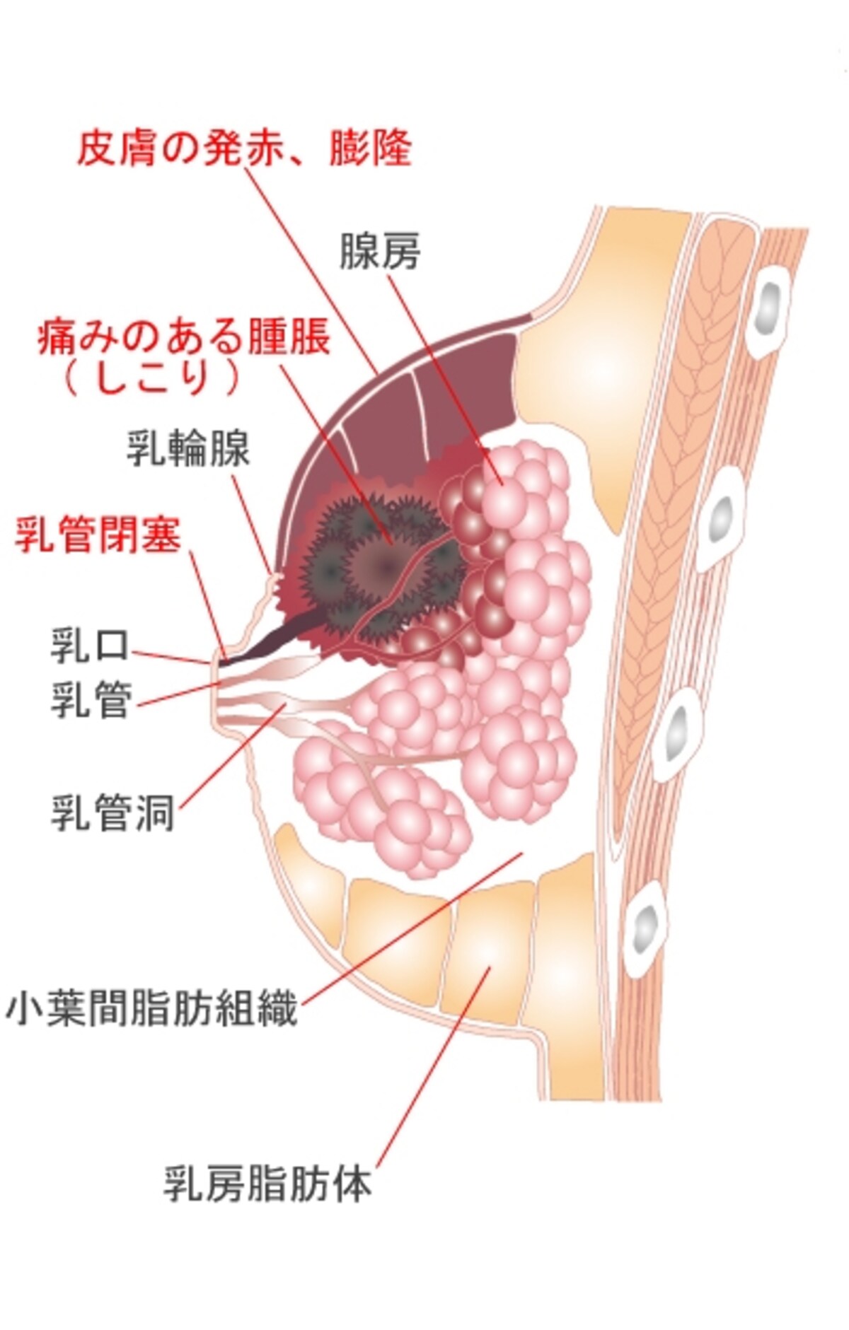 重症乳腺炎