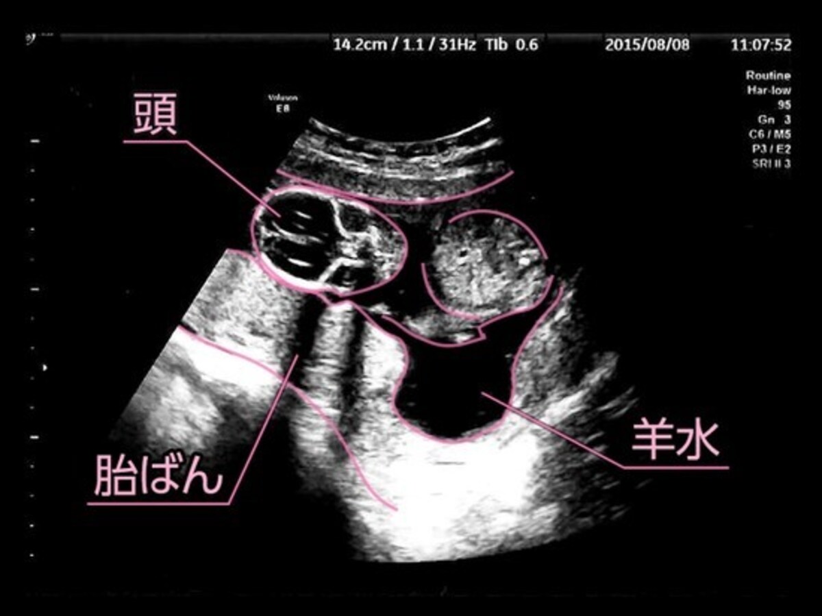 妊娠15週（妊娠4ヶ月,四ヶ月,4カ月）エコー写真・超音波写真