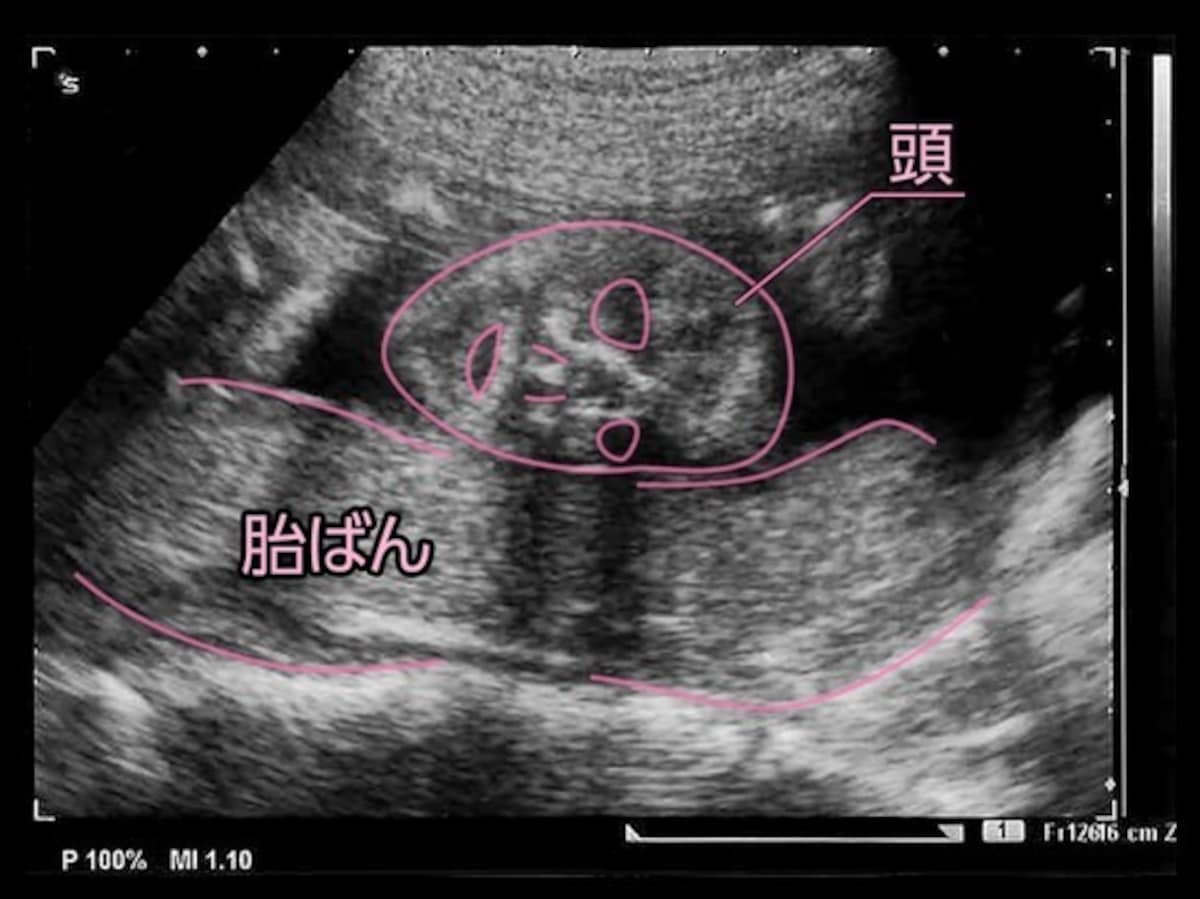 妊娠22週（妊娠6ヶ月,六ヶ月,6カ月）エコー写真・超音波写真