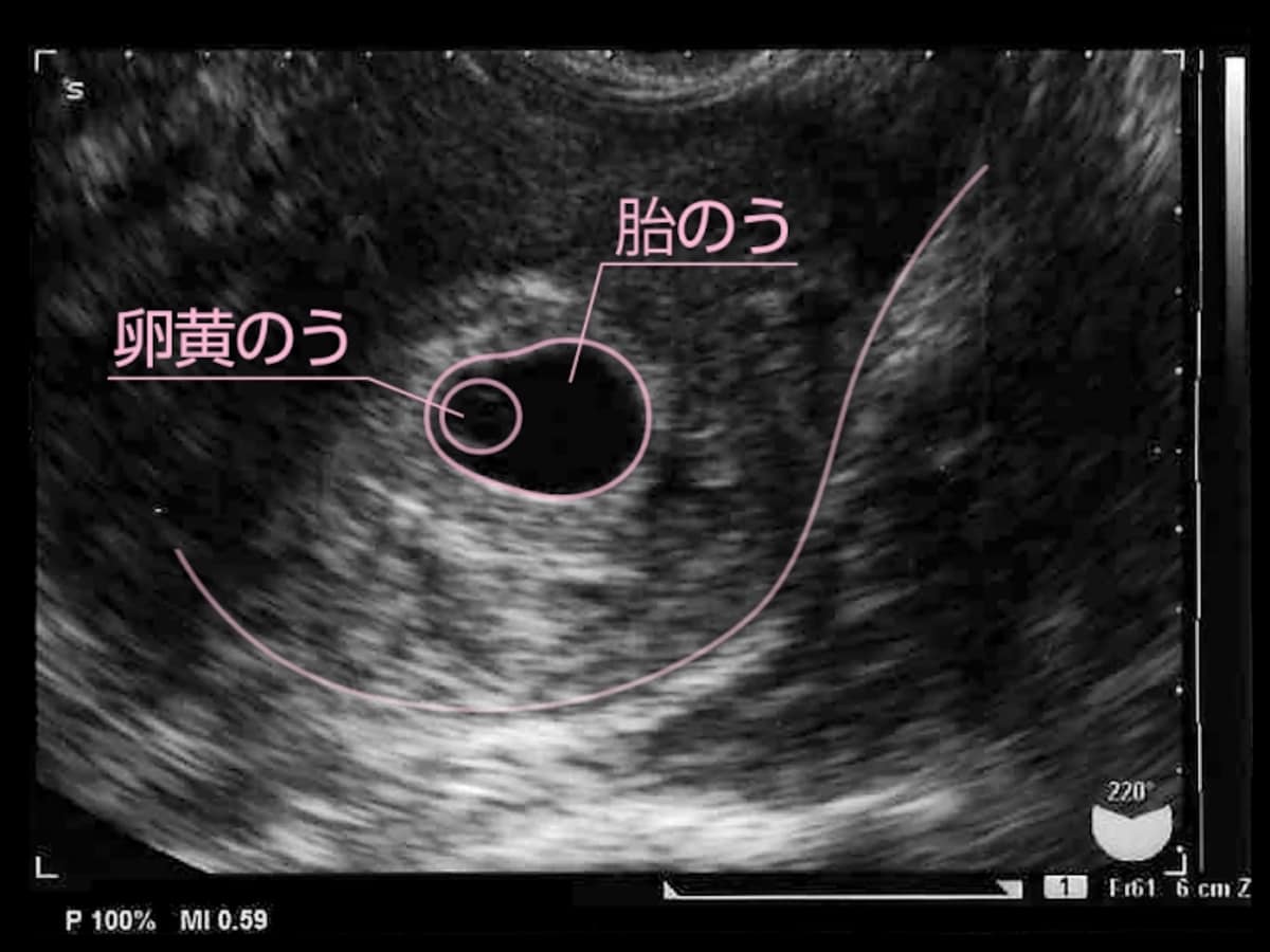 妊娠5週（5w）の胎児・胎芽・胎嚢のエコー写真・超音波写真