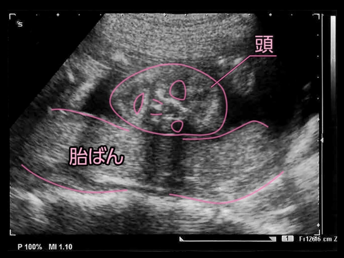 妊娠22週（22w）胎児のエコー写真・超音波写真