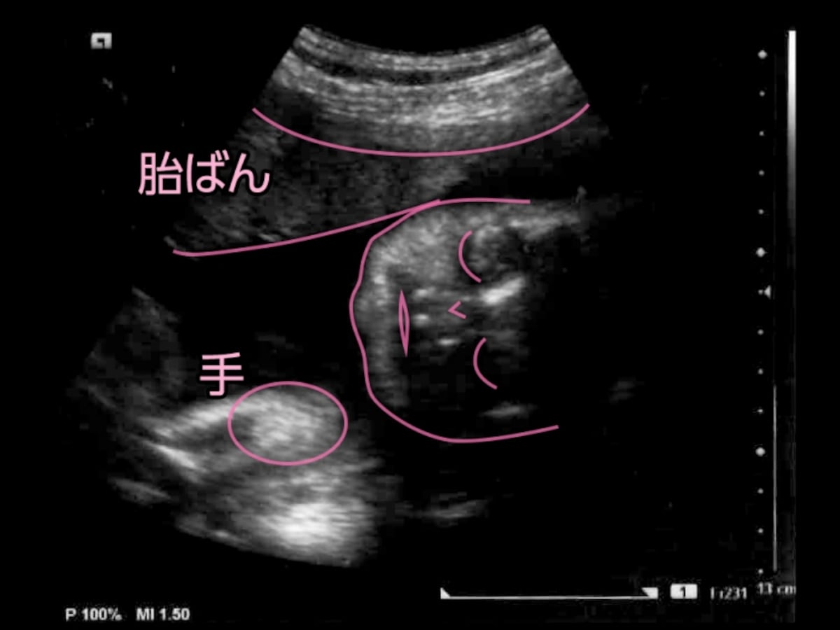 妊娠31週（31w）の胎児のエコー写真・超音波写真