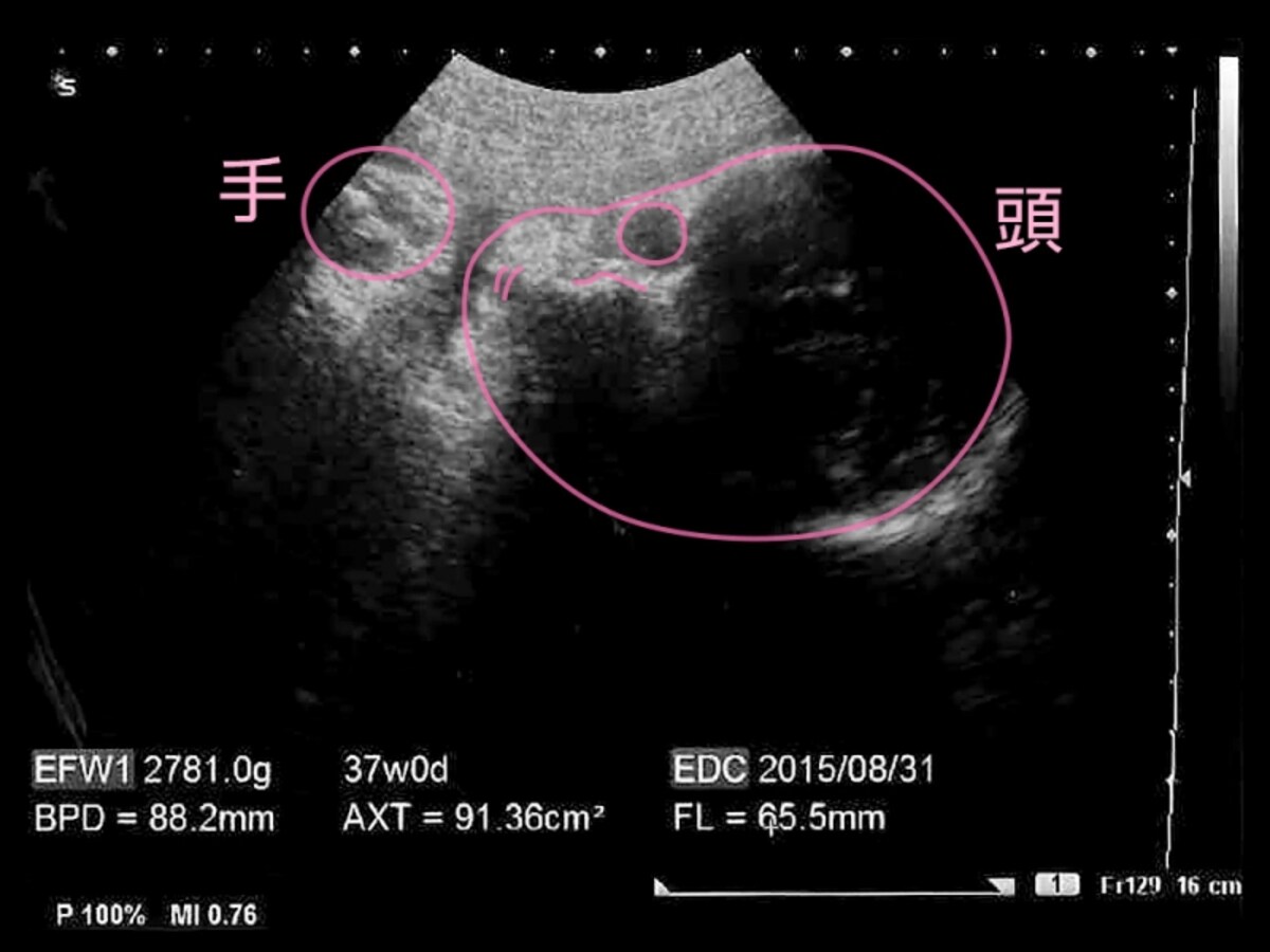 妊娠37週目（37w）の胎児のエコー写真・超音波写真