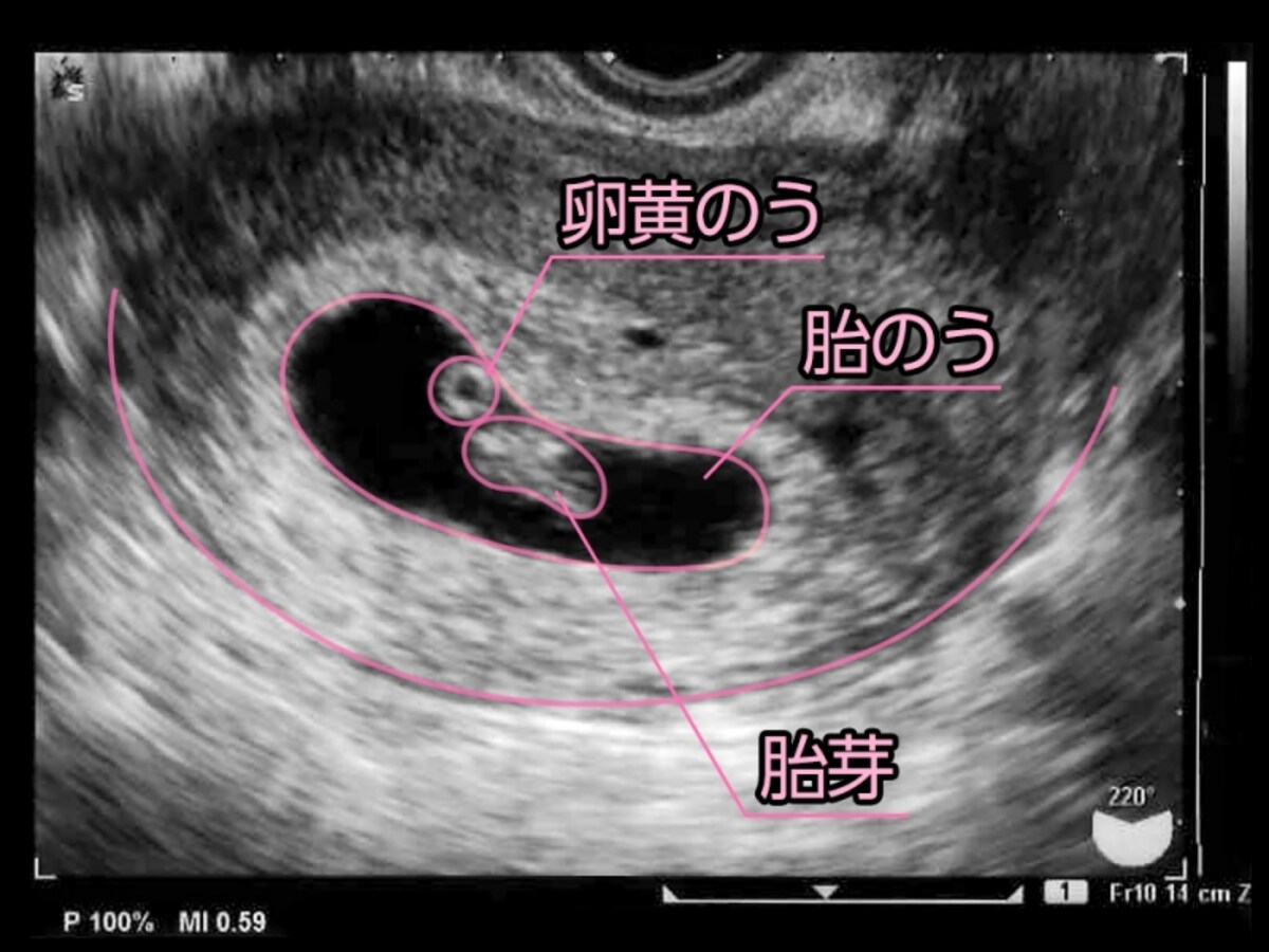 妊娠7週目（7w）胎芽・胎嚢・卵黄嚢のエコー写真・超音波写真