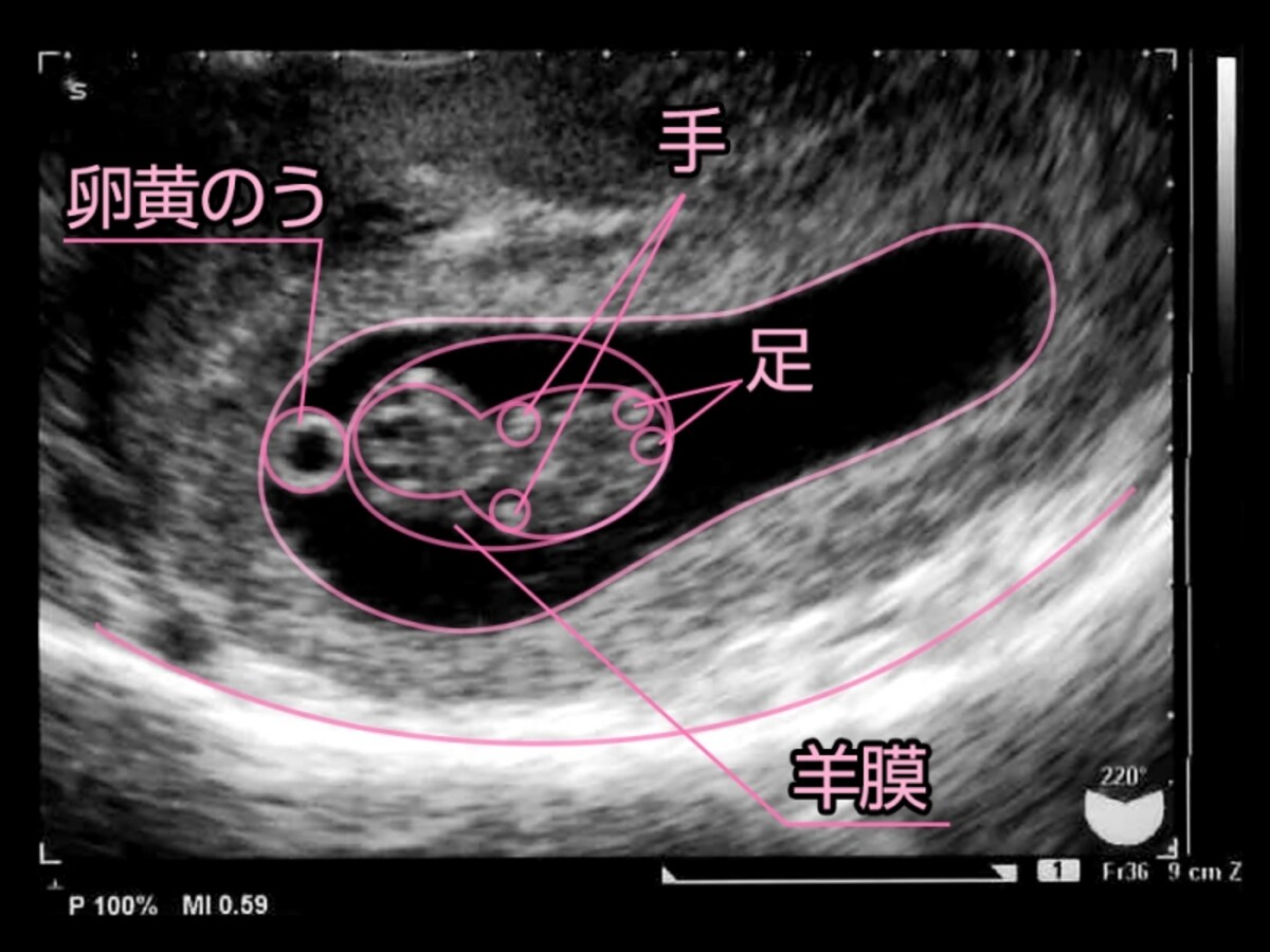 妊娠9週目（9w）の胎児のエコー写真・超音波写真
