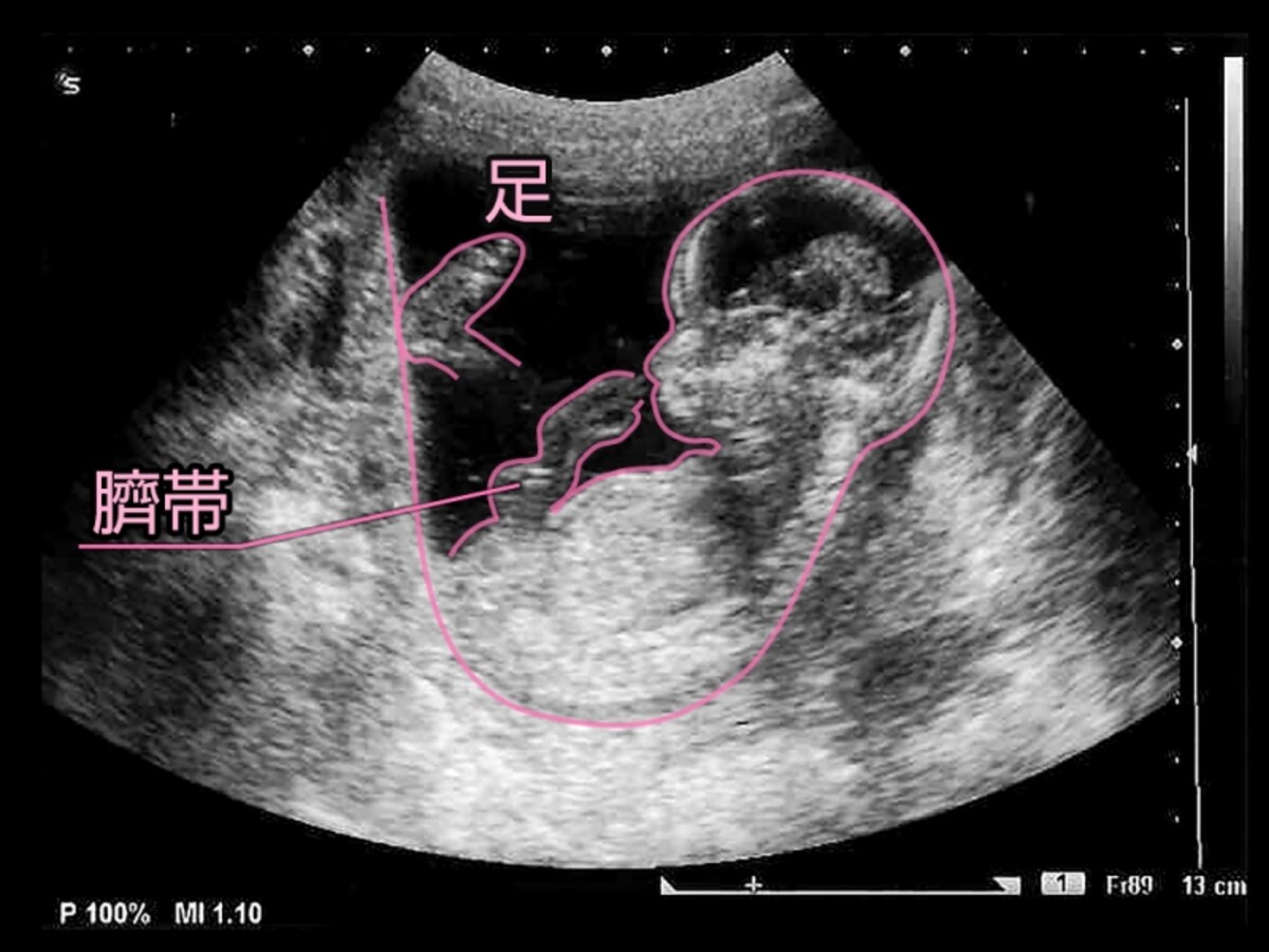 妊娠14週目、胎児のエコー写真・超音波写真