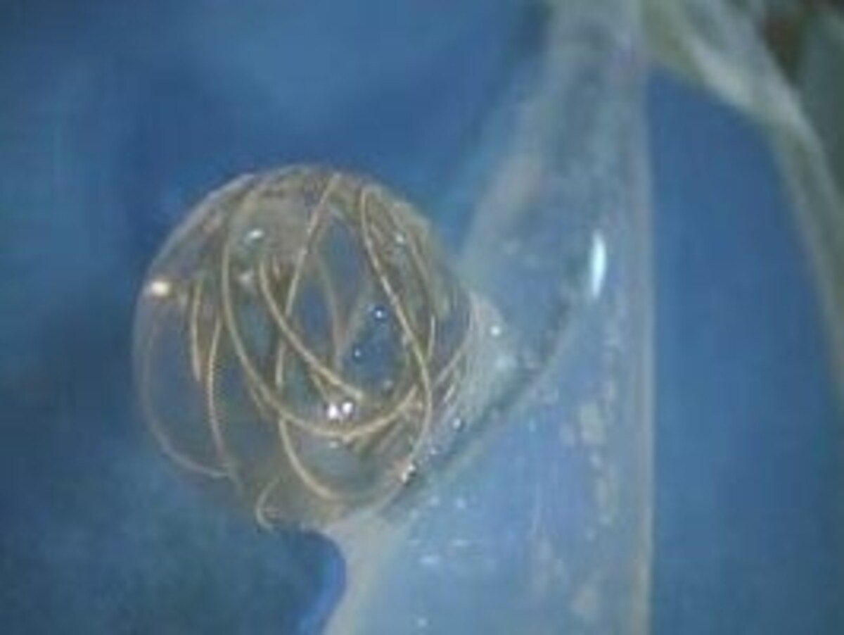 くも膜下出血