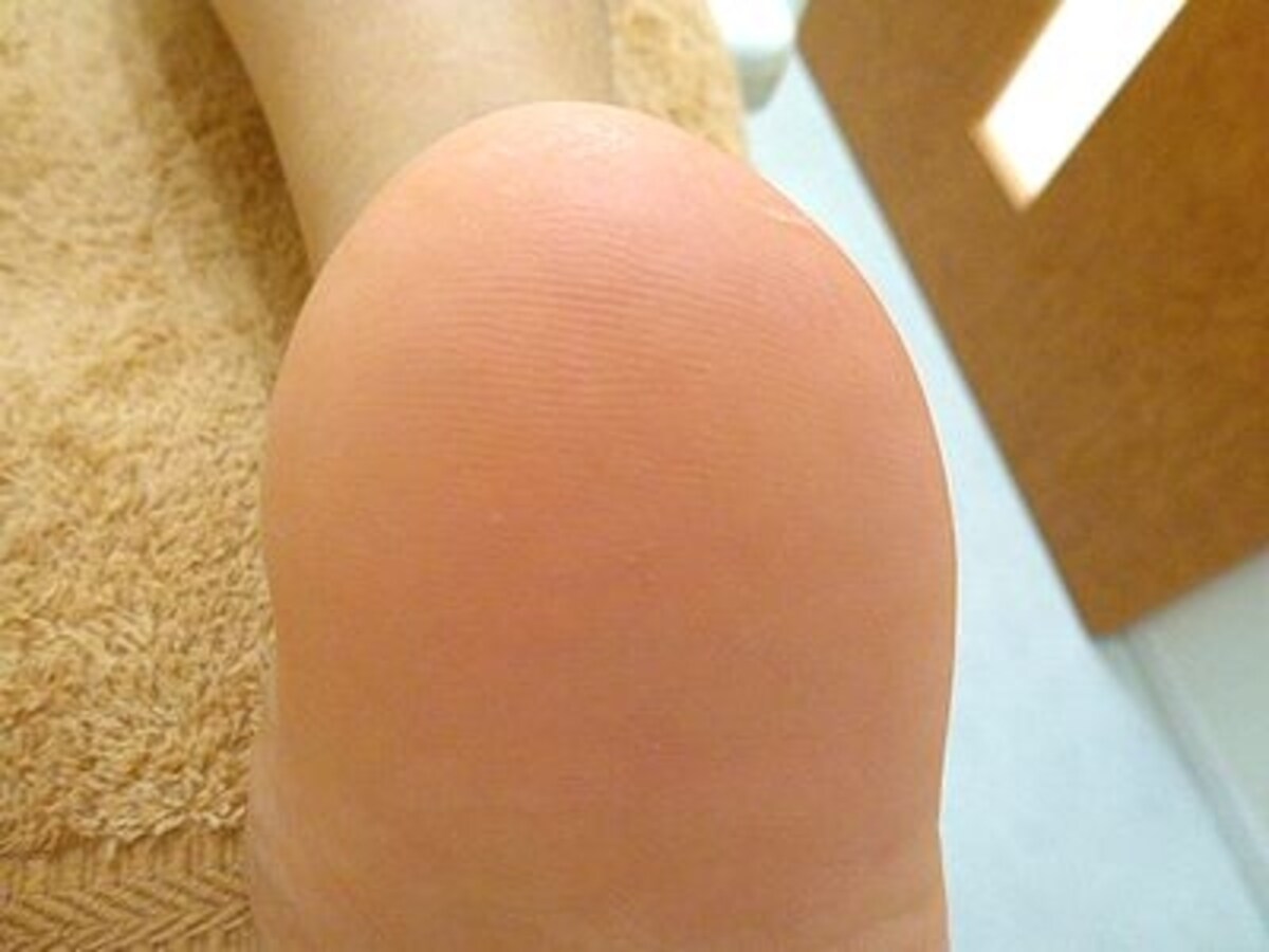 アフターかかと