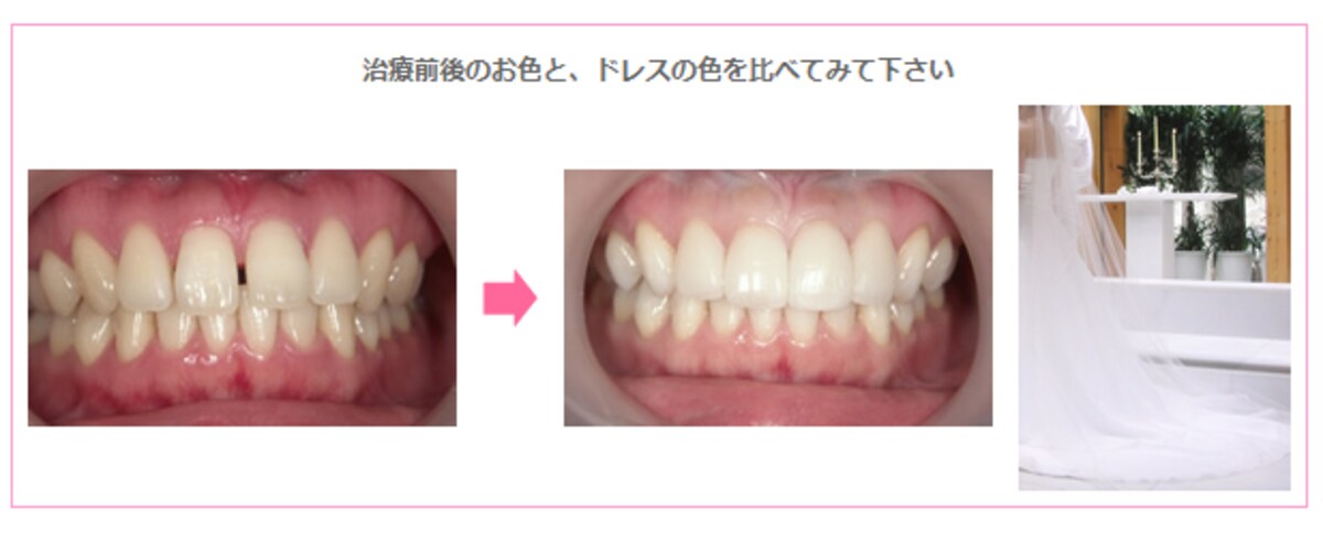 セラミック治療後の歯とドレスの色比較