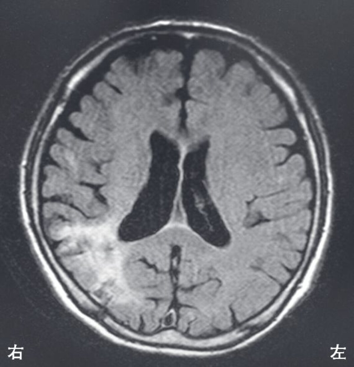 脳血管障害（理学療法士の国試）