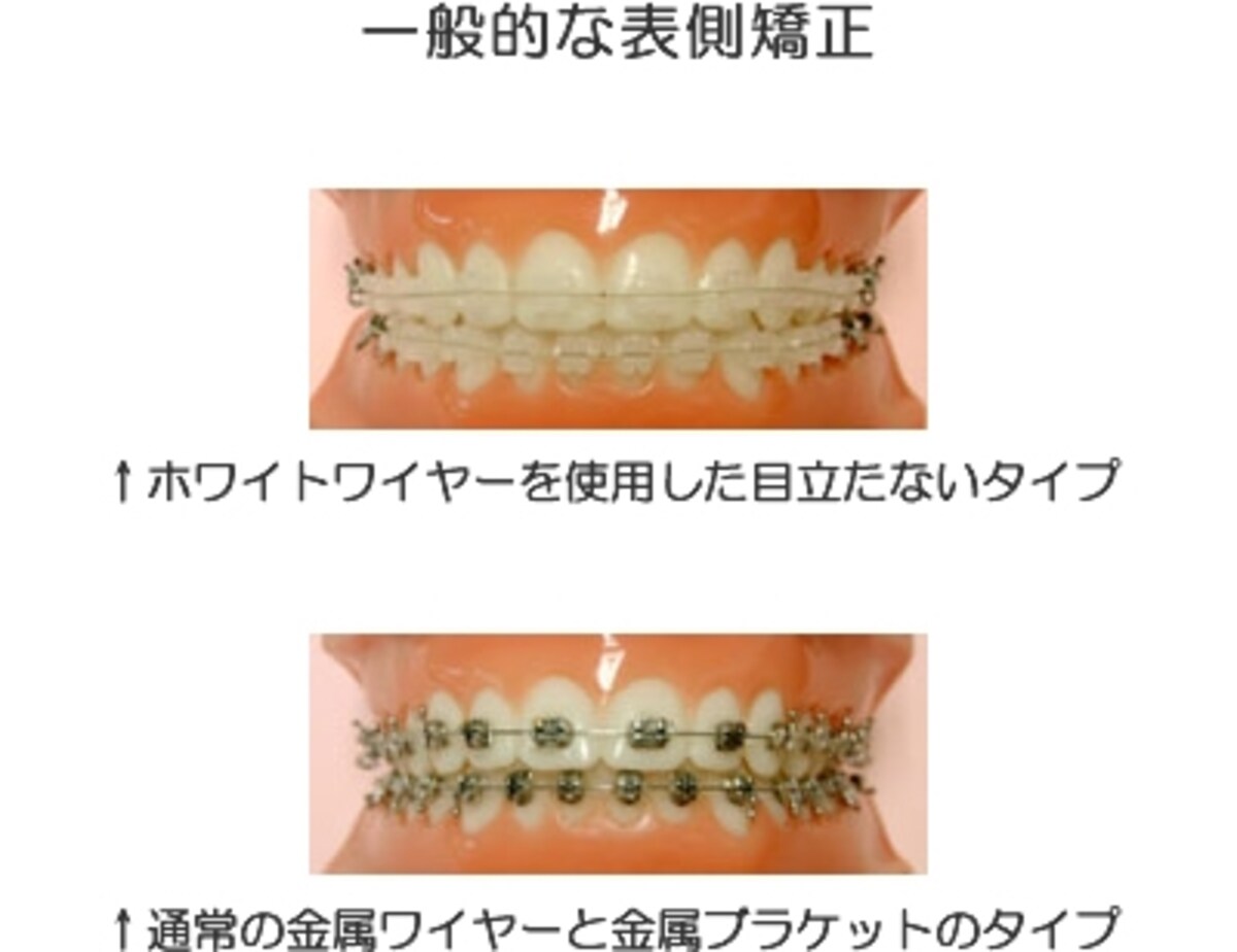 表側矯正