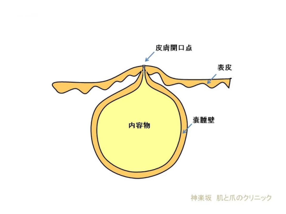 粉瘤断面図