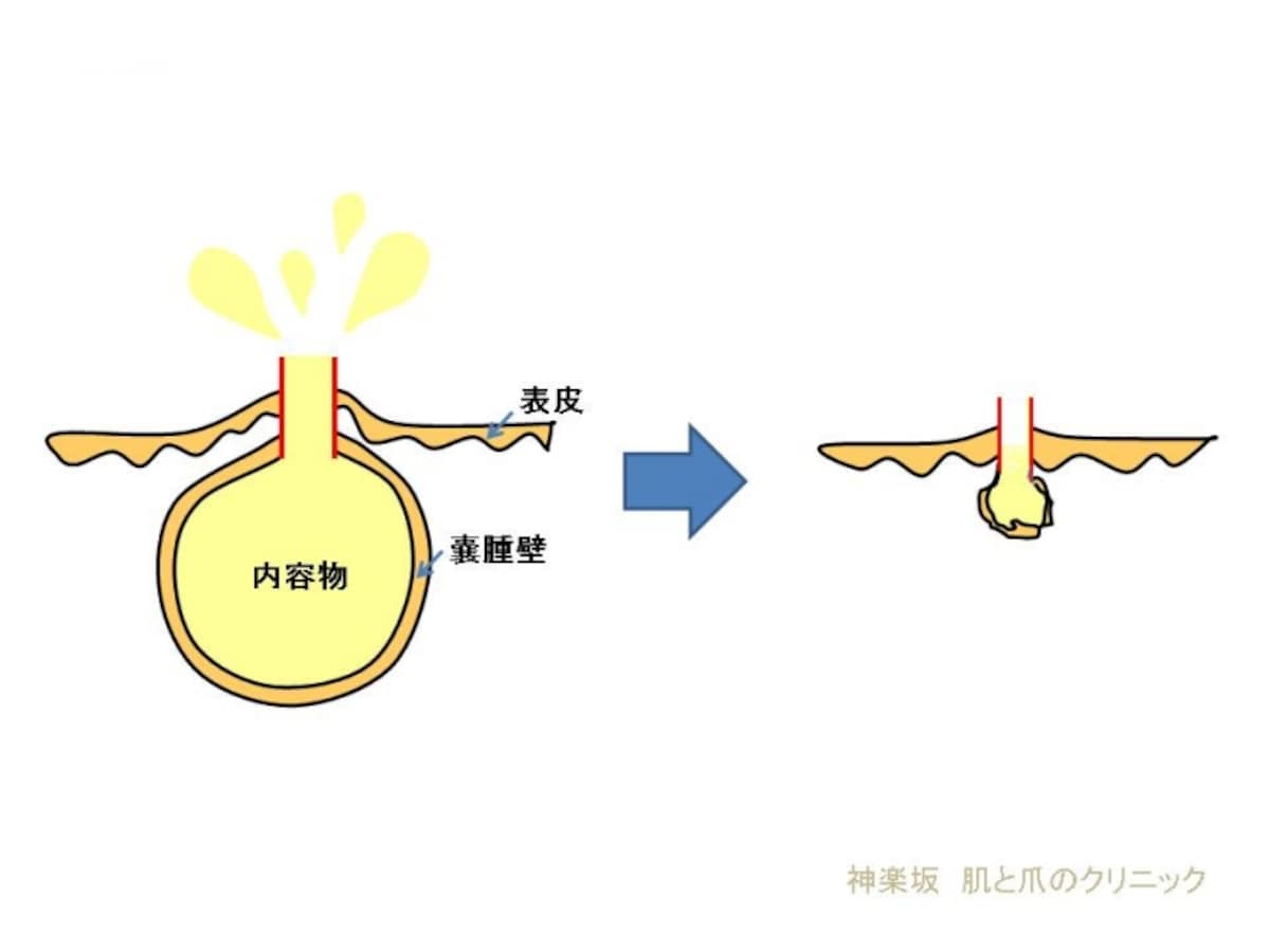 赤線が切開した部位　すべては取り除けない