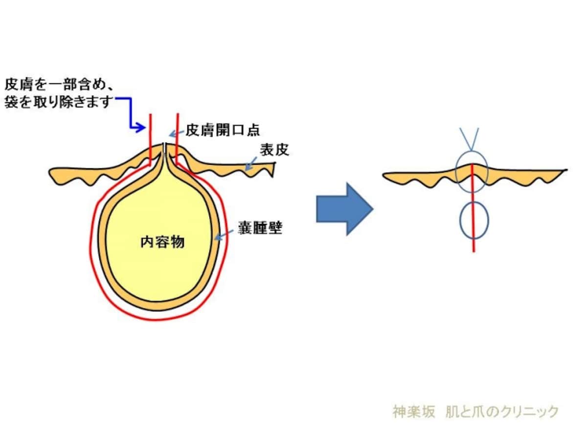 赤線は粉瘤手術で摘出する部分
