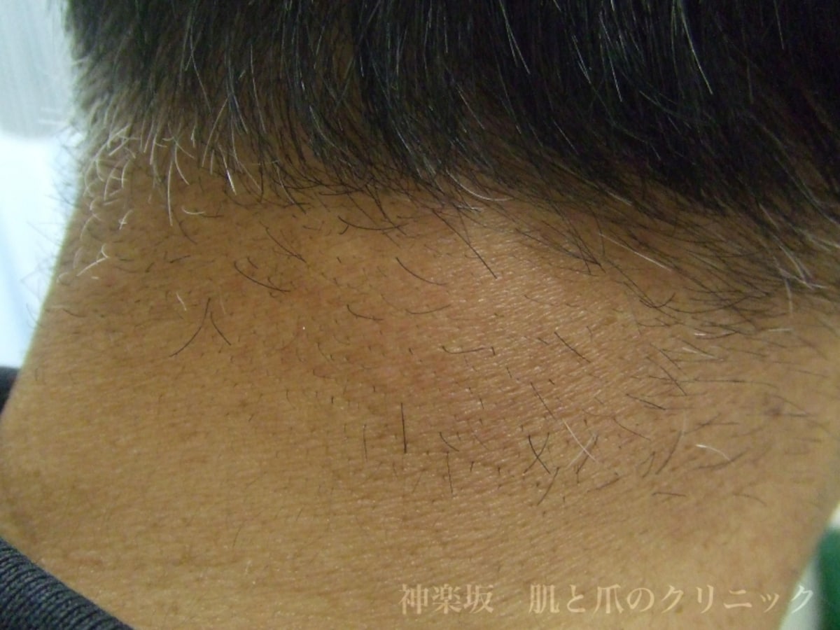 頸部（けいぶ）脂肪腫