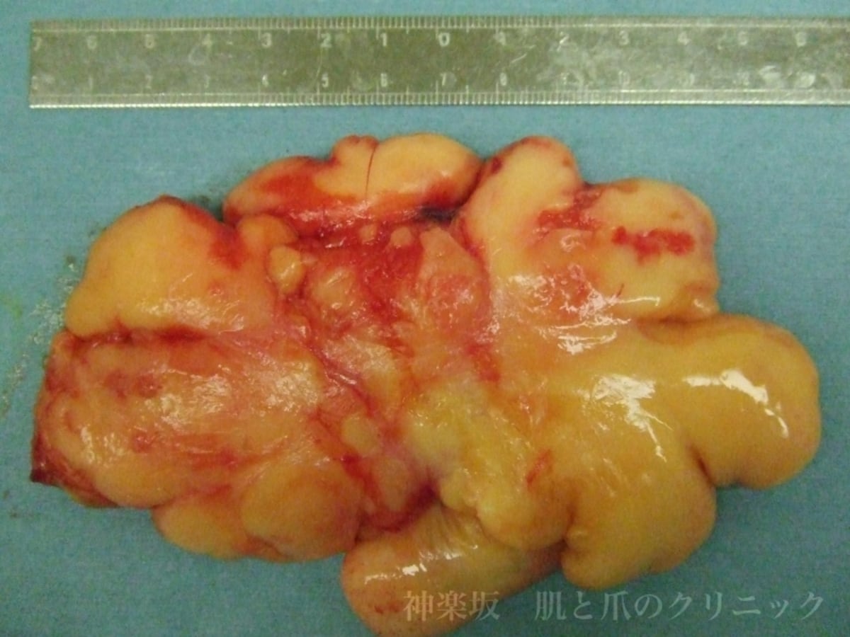 摘出した脂肪腫