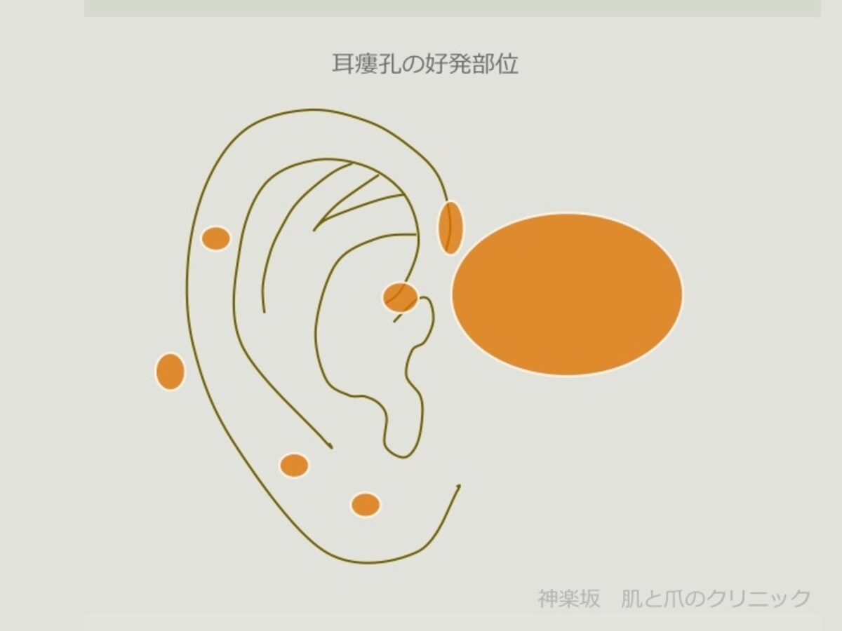 耳瘻孔のできやすい部位