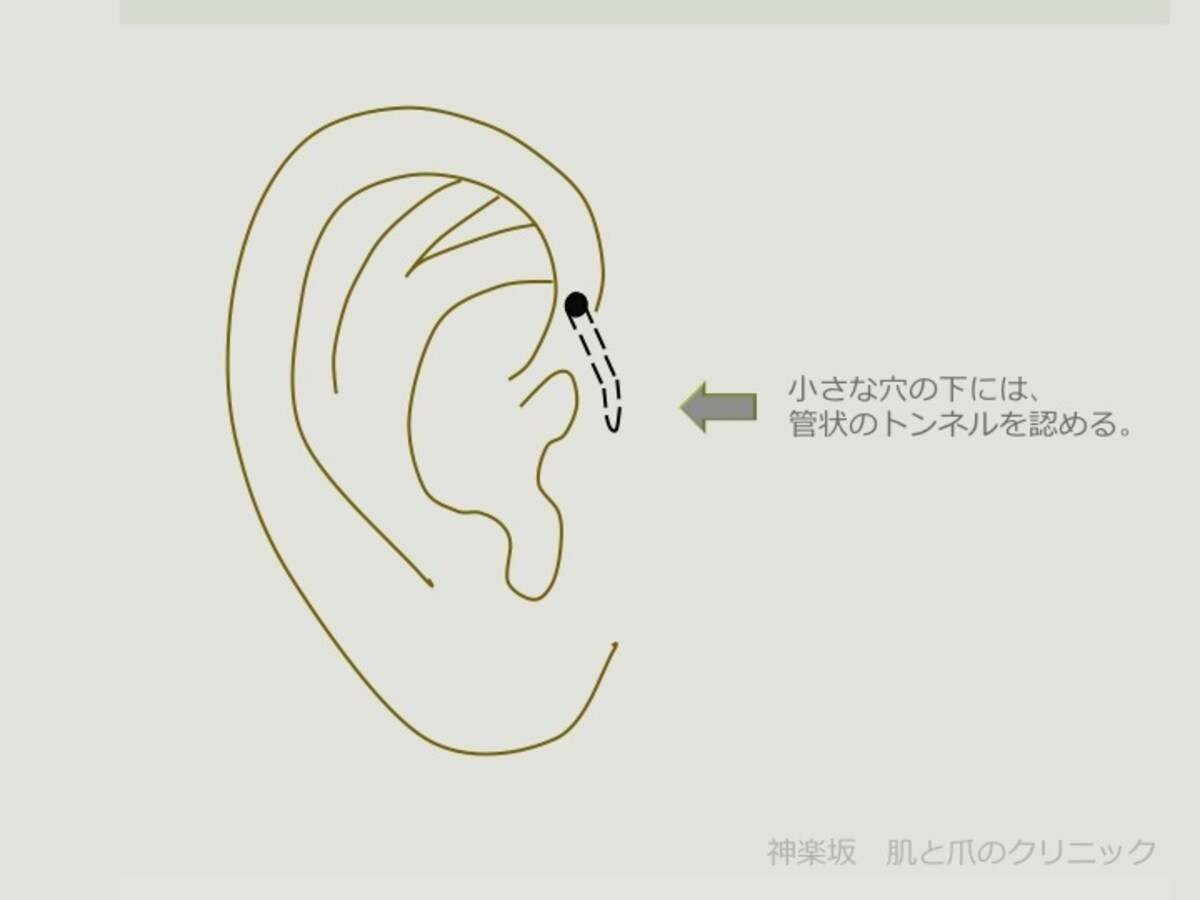 耳瘻孔　図説