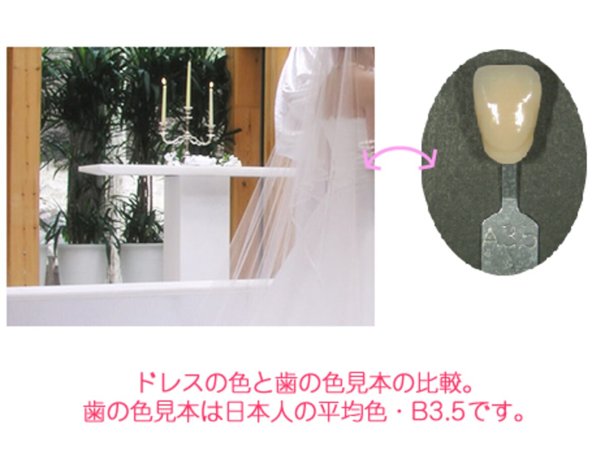 ドレスと歯の色B3.5の色比較