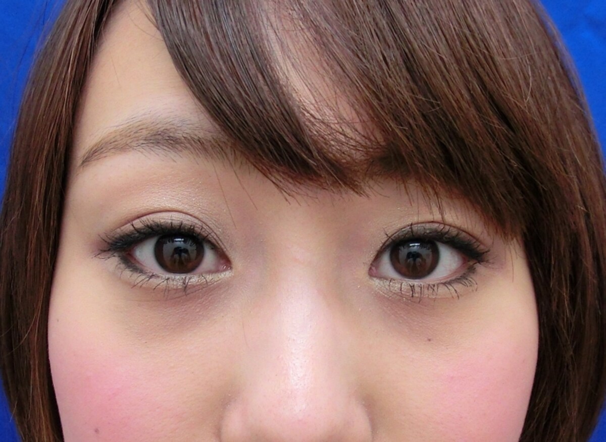 　目の下の色素沈着の症例です。赤クマは手術にて治療しました