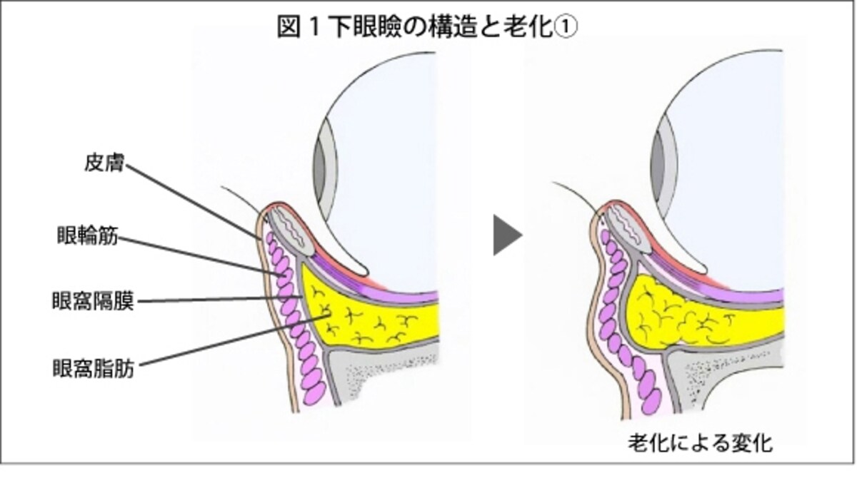 下瞼の構造です。黄色の部分が眼窩脂肪になります
