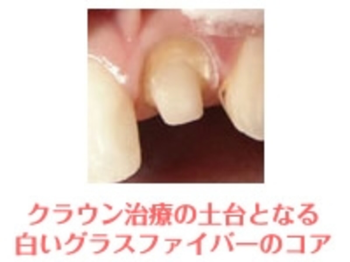 クラウン治療の土台となる、グラスファイバー製のコア