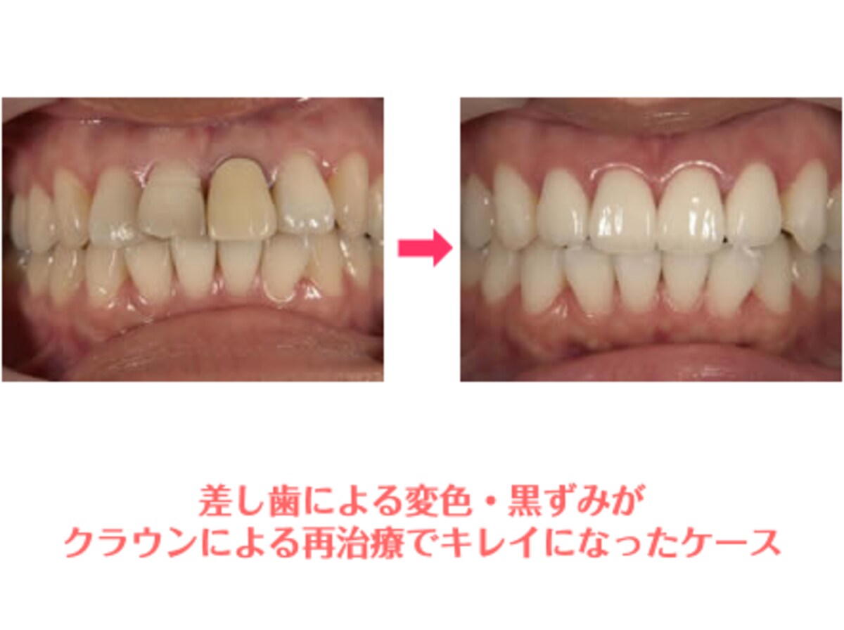 クラウンによる再治療で、差し歯の変色や黒ずみがキレイになったケース