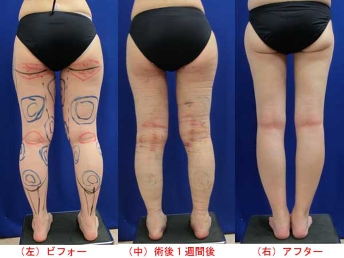 下半身脂肪吸引手術のビフォーアフター