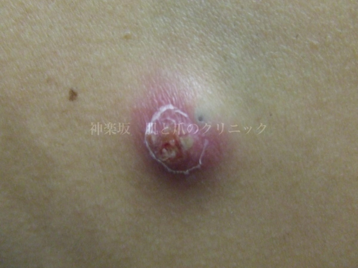 炎症性粉瘤