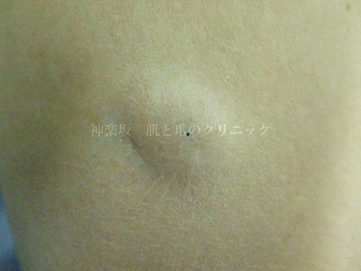 粉瘤