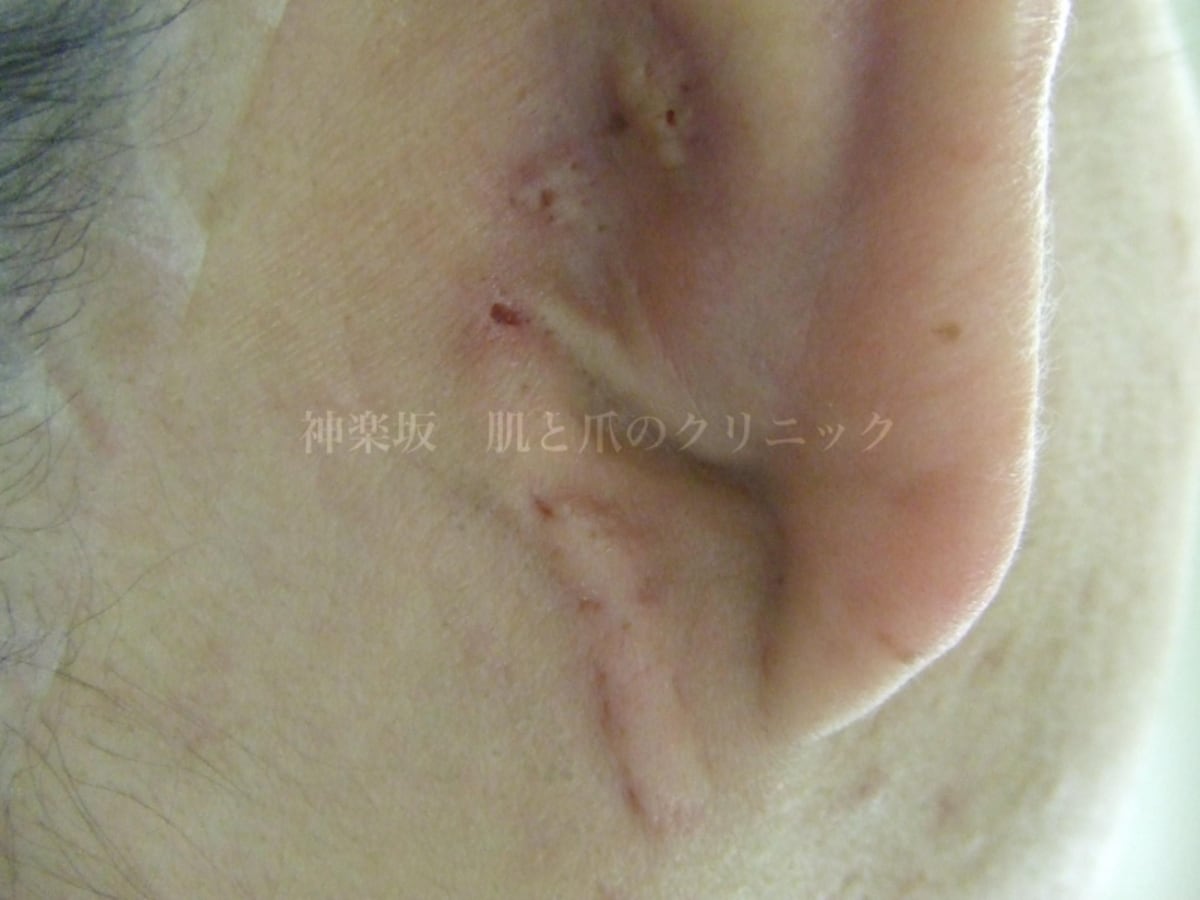 粉瘤（耳後部に多発している）