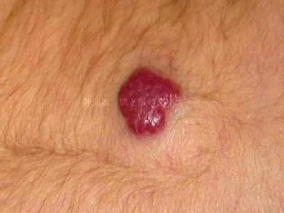 血管腫（乳児血管腫）